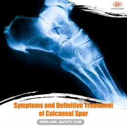 Symptoms and Definitive Treatment of Calcaneal Spur